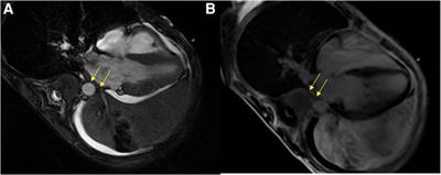 Atrial fibrillation in a pediatric patient caused by an unusual malignant etiology: A case report